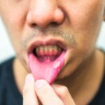 Inflammatory Bowel Disease Effects on Oral Health