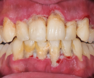 periodontal-disease